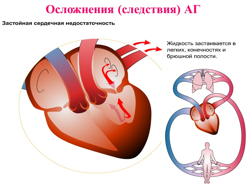 Осложнения (следствия) АГ